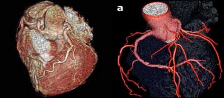 3-D реконструкция коронарных артерий  при МСКТ. Визуализируются ствол ЛКА, ПМЖА, ПКА по всей длине.