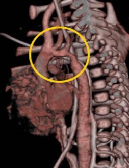 МСКТ у пациента с коарктацией аорты