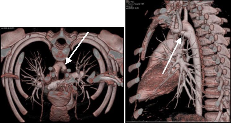 Аномалия развития, двойная дуга аорты (стрелки)