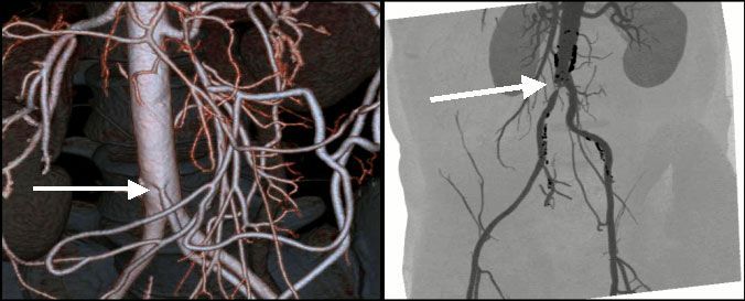 МСКТ 3-D реконструкция брюшной аорты и периферических артерий. Справа: стеноз верхней мезентериальной артерии (стрелка). Слева: окклюзия правой подвздошной артерии (стрелка)