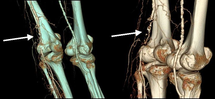 -D реконструкция периферических артерий при МСКТ. Окклюзия левой подколенной артерии (стрелка). Множественные атеросклеротические поражения, правой бедренной и правой подколенной артерии
