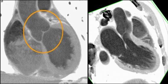 МСКТ. Артальный клапан (слева), митральный и аортальный клапаны (справа). Норма
