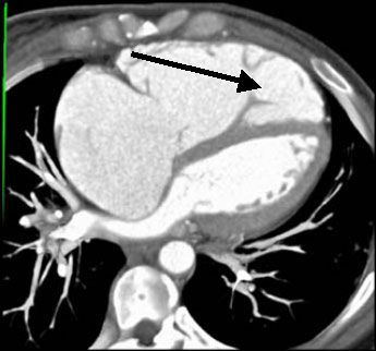 МСКТ сердца. Визуализируется увеличенный правый желудочек (стрелка)