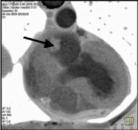 МСКТ сердца, миксома левого предсердия (стрелка)