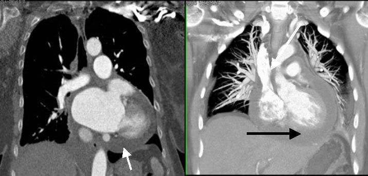 Экссудативный перикардит, выпот (стрелки).