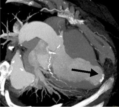 МСКТ сердца. Разрыв межжелудочковой перегородки при остром инфаркте миокарда (стрелка).