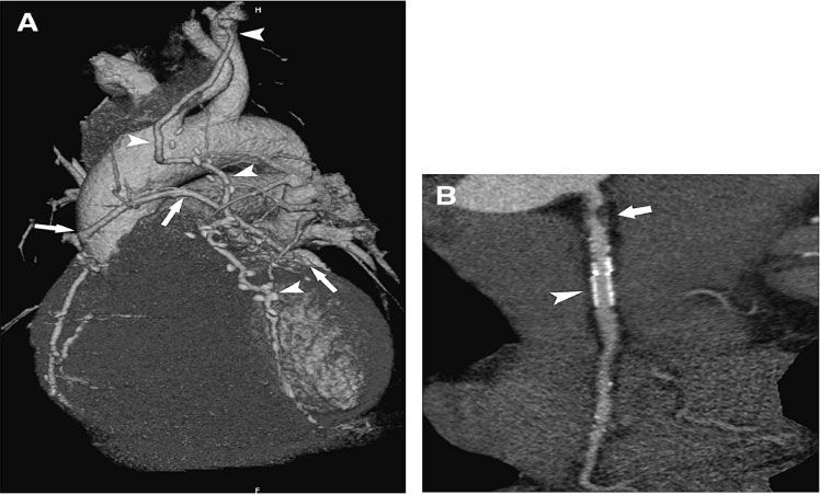 3-D реконструкция у пациента после АКШ и ЧТКА со стентированием.</b><br><div align=right>Рисунок слева: стрелками отмечены аорто - коронарные шунты. Рисунок справа: стеноз проксимального сегмента коронарной артерии и ниже - функционирующий стент