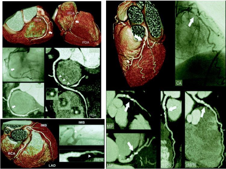 рямое сравнение результатов селективной КАГ и 64- МСКТ. Справа: стеноз среднего сегмента ПКА (стрелки), слева: стеноз проксимального сегмента ПМЖА (большие стрелки), в области поражения - визуализируются включения кальция.