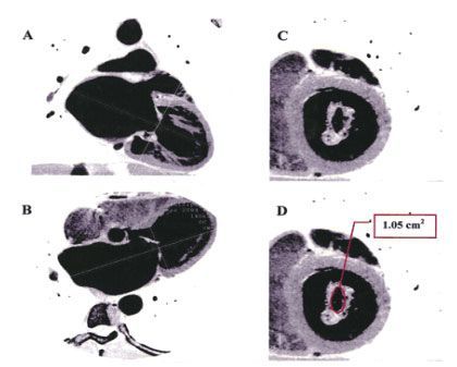 МСКТ с контрастированием (белый и черный цвета реверсированы для сходства с ЭХОКГ). После адекватной ориентации по длинной оси в 2 камерную позицию (A) в четырех камерную (B) срез через митральный клапан (C) измерение площади раскрытия митрального клапана (D).