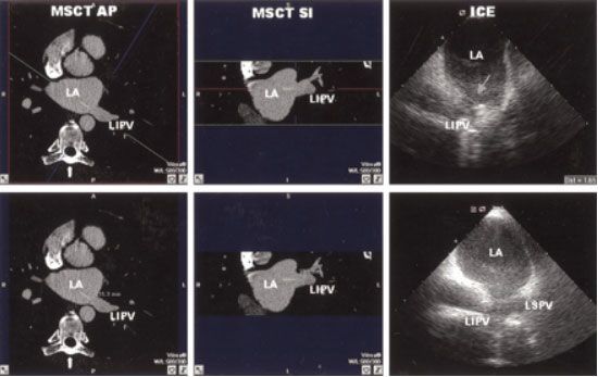 змерения левой нижней легочной вены (LIPV)  при МСКТ (слева) и при трансторакальной ЭХОКГ (справа). LA-левое предсердие. LSPV –левая верхняя легочная вена.