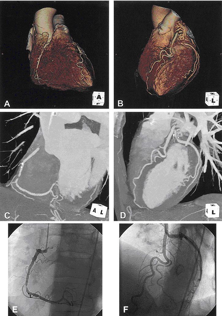КАГ (E, F) и МСКТ коронарных артерий( A, B, C, D). Гемодинамически значимый стеноз ПКА (стрелки)