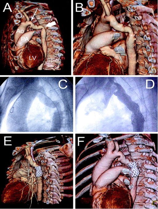 МСКТ у пациента с коарктацией  аорты (А,В) (стрелка). Аортография (С,D). Контроль за эффективностью эндоскопического лечения, последующее наблюдение(E,F)