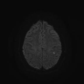 Инфаркт головного мозга (лакунарный инфаркт)