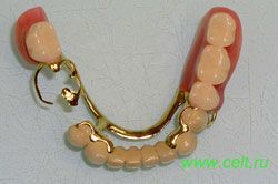 Бюгельные протезы