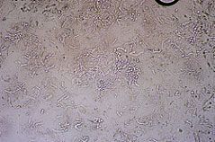 Разноцветный лишай или pityrosporum